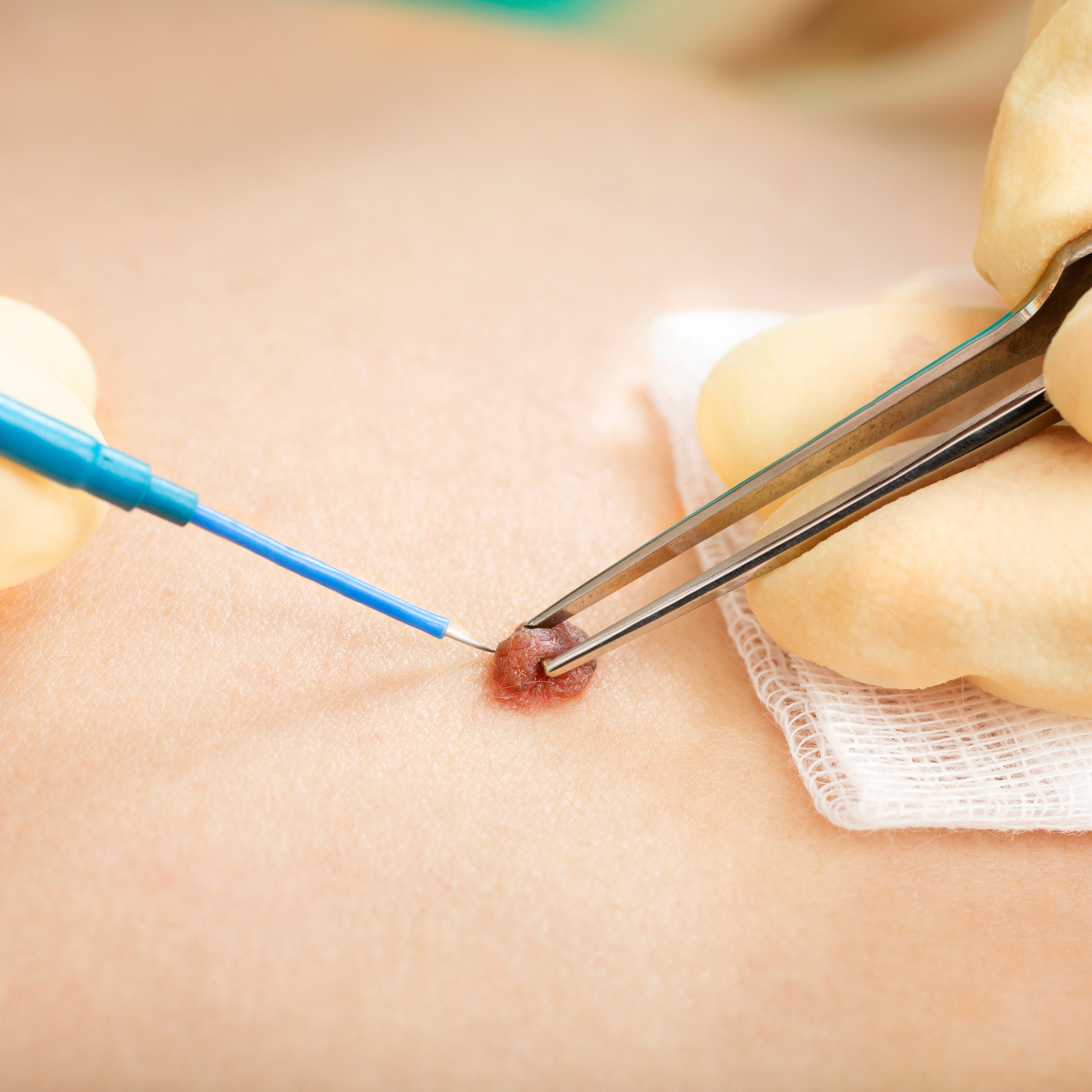 Advanced Blemish Removal (Diathermy) Masterclass